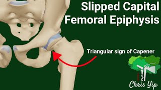 Slipped Capital Femoral Epiphysis  XRays Explained Animated [upl. by Flan524]