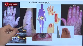 Artrite psoriasica sintomi diagnosi e trattamenti con nuovi farmaci biotecnologici [upl. by Dahsra380]