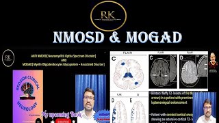 By Dr Ramesh Krishnan Neurologistnmosd diseaseoptic neuritismogad diseasemultiple sclerosis [upl. by Judson]