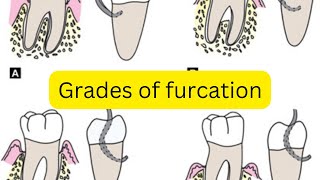 Grades of furcation involvement MADE EASY [upl. by Cadmar]