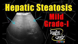 Mild Hepatic Steatosis  GradeI Fatty Liver  Ultrasound  Case 226 [upl. by Henig]