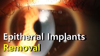 Manual Removal of Epithelial Implants [upl. by Idner127]