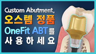 Custom Abutment 오스템 정품 OneFit ABT를 사용하세요 [upl. by Elohcan978]