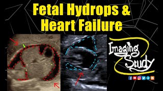 Fetal Hydrops amp Heart Failure  Ultrasound  Anomaly  Case 293 [upl. by Hanselka868]