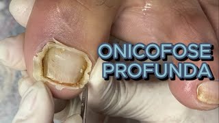 REMOÇÃO DE ONICOFOSE PROFUNDA COM PEELING satisfying viral [upl. by Siramaj]