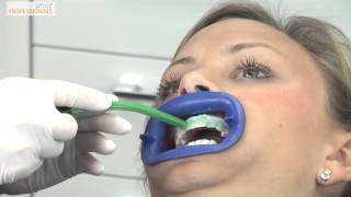 Weiße Zähne durch Bleaching  Zahnaufhellung  Zahnarzt Gundelfingen  Smile Professionals [upl. by Sorensen399]