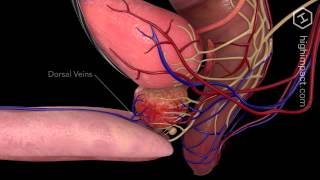 Open Prostatectomy [upl. by Oiratno865]