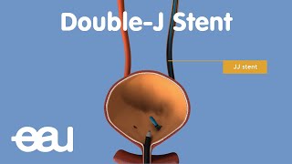 JJ Stent removal of kidney stones [upl. by Attenyt894]