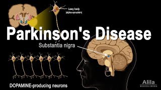 Parkinsons Disease Animation [upl. by Arytal]