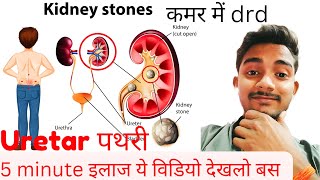 Kidney stonesUreter stone 🪨Cause Symptoms Treatment only in 5 minute [upl. by Yensehc]