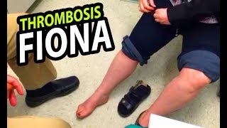 Fionas Phlebitis and Thrombosis Redux [upl. by Kassandra]