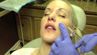 Botox amp Juvederm Lip Injection in Virginia by Dr Naderi DC VA MD [upl. by Thorndike]