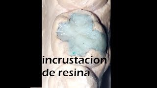 incrustacion dental estetica onlay de resina tecnica indirecta [upl. by Amzaj]