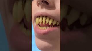 Why Is This FRIGHTENING Tooth Trend Is Taking Over 🧛🦷 [upl. by Nairrad]