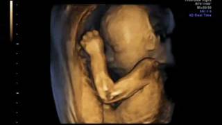 3D ultrasound 25 weeks 4D view of baby 25 week pregnancy baby girl first view [upl. by Ailegnave]