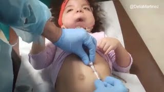 CAMBIO DE BOTON GASTRICO Con Cirujano Gástrico  GASTROSTOMIA [upl. by Longtin421]