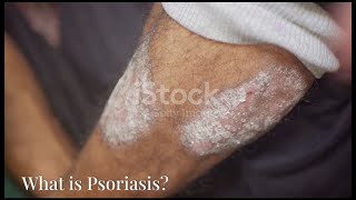 psoriasis explaining psoriasis Signs Symptom and treatment [upl. by Vere65]