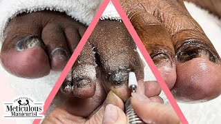 Thick Toenails Pedicure Tips and Conservative Care [upl. by Nrubyar]