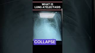 How To Remove Mucus from Lungs I Collapsed Lung I Atelectasis I Treatment [upl. by Aynam899]