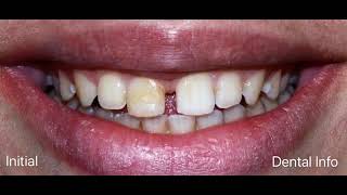 Diastema Closure Step By Step [upl. by Ekusuy]