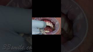 Correcting discolored teeth with prepless veneers before and after [upl. by Iek733]