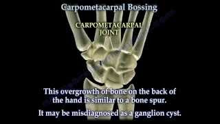 Carpometacarpal Bossing  Everything You Need To Know  Dr Nabil Ebraheim [upl. by Ferdy]