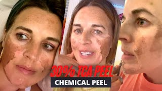 BEFORE AND AFTER 30 TCA Chemical Peel Procedure Peeling Herpes [upl. by Dryfoos]