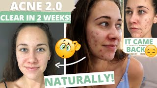 ACNE 20  How to get rid of CYSTIC acne NATURALLY in TWO WEEKS [upl. by Einhapets]