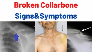 Broken Collarbone Clavicle Bone Fracture Causes Symptoms Treatment Surgery [upl. by Piane]