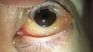 Chemosis of Conjunctiva [upl. by Leitnahs468]