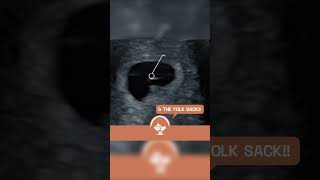 Yolk Sack and Heartbeat at 6 weeks Pregnancy EarlyDetection ViabilityScan [upl. by Ingaberg]