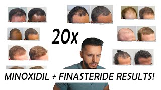 20 Finasteride and Minoxidil before and after Results NW2  NW56 [upl. by Essex]