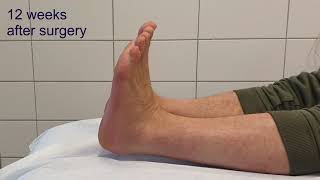 calcaneus fracture comminuted Sanders 4  minimal invasive surgery  clinical course [upl. by Brosy]