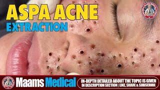 Aspa Acne Symptoms Causes and Effective Treatments  Tips for Clear Skin Solutions  Maams [upl. by Gibun]