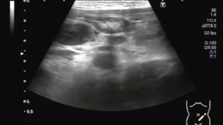 Ultrasound Video showing Mesenteric lymphadenitisLymphadenopathy or adenopathy [upl. by Barth845]