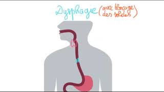 🔴 LA DYSPHAGIE AUX SOLIDES QUI BLOQUENT [upl. by Ruiz715]