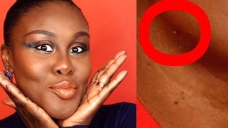 How To Get Rid of Skin Tags  Easy DIY at Home  Beauty Hacks  Fumi DesaluVold [upl. by Natala276]