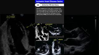 Ischemic Heart Disease 4 Anterior Myocardial Infarction [upl. by Ford]