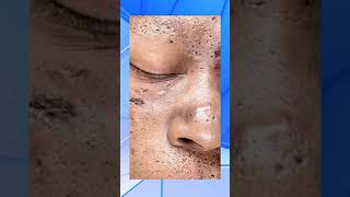 Black head acne [upl. by Lexine]