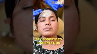 COSMELAN PEEL TREATMENT AT DRKASANAS CLINIC [upl. by Loring216]