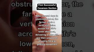 The First Successful Cesarean Section in History shorts [upl. by Enneiluj]