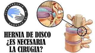 ¿Es necesaria la cirugia de hernia discal [upl. by Leinehtan]