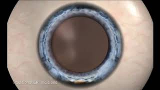 Traditional Cataract Surgery vs NEW Bladeless Laser Cataract Surgery [upl. by Icyac]