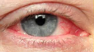 Eye cancer symptoms [upl. by Soni]