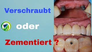 Verschraubt oder zementiert  Implantat Kronen und Brücken [upl. by Mannos]