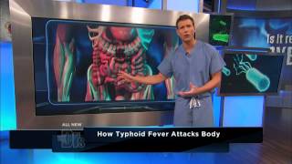 How Typhoid Fever Affects the Body  The Doctors [upl. by Eicam]