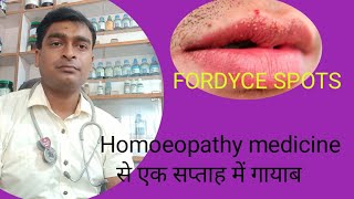 FORDYCE SPOTS cause symptoms and homoeopathic remedies [upl. by Iaht]