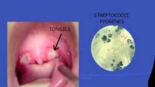 Streptococcal pharyngitis [upl. by Yarak329]