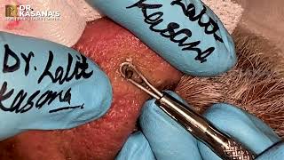 70 YEAR OLD NOSE BLACKHEADS REMOVAL AT DRKASANAS CLINIC [upl. by Yaja]