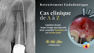 Retraitement endodontique Cas Clinique de A à Z fistule screw post obturation et controle [upl. by Onitram]